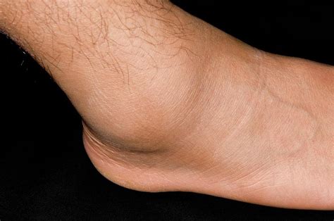 Sprained Ankle Sports Injury Photograph By Dr P Marazziscience Photo