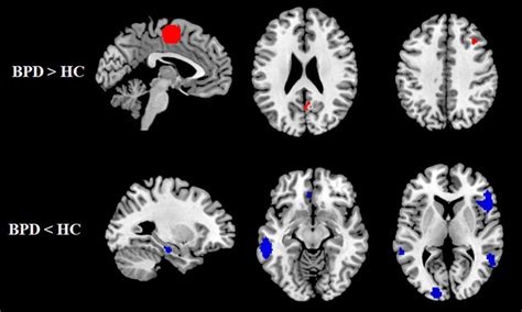 Regions Showing Gray Matter Alteration In Bpd Patients Compared With