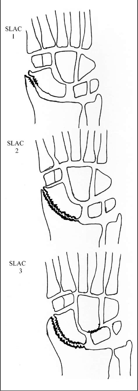 Figure From Trail Nonunion Advanced Collapse Snac Wrist Reproducibility Of Radiographic