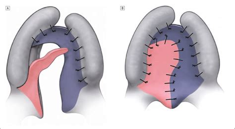 Flap Closure A Flaps On The Hard Palate Are Elevated Transposed And