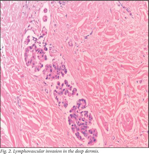 Figure 1 From The Histology Of Peau Dorange In Breast Cancer What