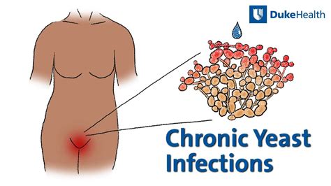 Chronic Yeast Infections Causes And Treatment Duke Health Youtube