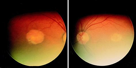 North Carolina Macular Dystrophy Clinicopathologic Correlation