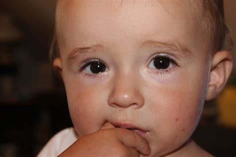 Vitiligo En NiÑos ¿qué Es Causas Síntomas Tratamiento Y Más