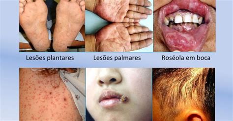 Enfermedades Infecciosas Causas Y Factores De Riesgo De La SÍfilis