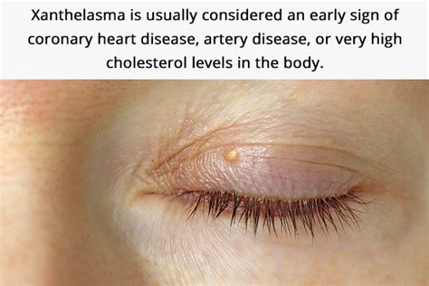 Ways To Deal With Cholesterol Deposits Around Your Eyes Healty Mind Blog