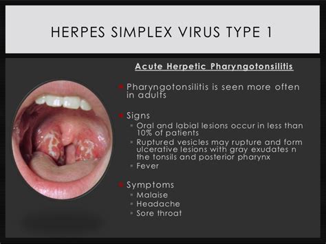 Check out inspiring examples of hsv1 artwork on deviantart, and get inspired by our community of talented artists. Genital Herpes Simplex 1 Virus On Finger — Herpes Free Me