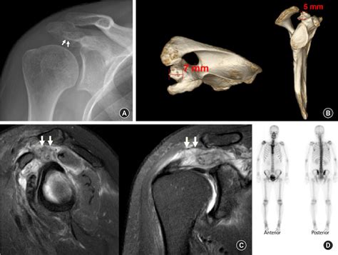 Figure 1 From Arthroscopic Excision Of Heterotopic Ossification In The