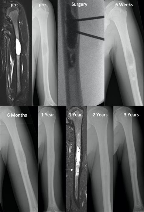 A 15 Year Old Male Patient With A Recurring Unicameral Bone Cyst After