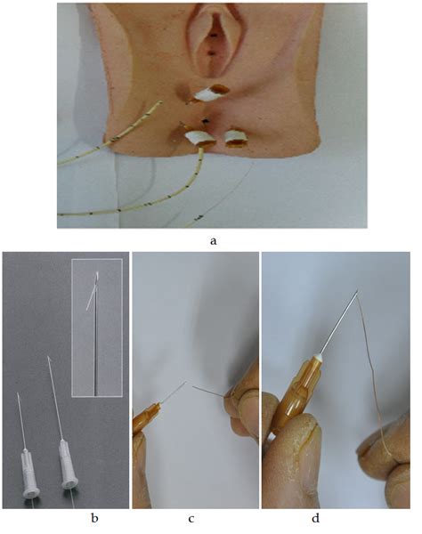 Anal Sphincter Electromyogram For Dysfunction Of Lower Urinary Tract And Pelvic Floor IntechOpen