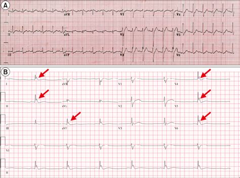A A Twelve Lead Electrocardiogram Ecg Sinus Tachycardia With St
