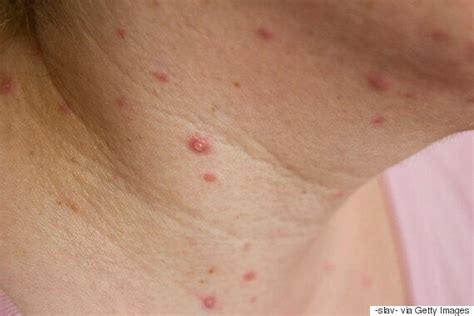 Los episodios de herpes zoster comienzan con comezón, adormecimiento, sensación de hormigueo o dolor severo y a la manera de un cinturón, en el pecho los episodios de culebrilla o herpes zoster generalmente ocurren de un solo lado del cuerpo. Adult Chicken Pox: Symptoms And Treatment For The Virus ...