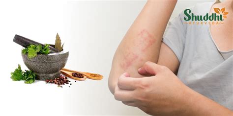 7 Natural Skin Allergy Home Remedies Shuddhi Ayurveda