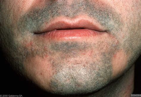9 natural treatments for alopecia areata. Alopecia areata: sintomi, cause, trattamenti