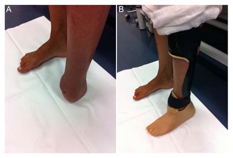 Ankle Dorsiflexion Arthrodesis To Salvage Choparts Amputation With