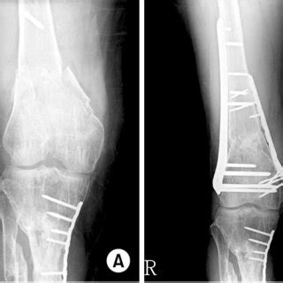 Displaced distal femur fractures may result in injury to the popliteal artery. (PDF) Treatment of Distal Femur Fracture