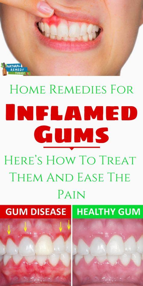 How To Reduce Gum Swelling Quickly Health