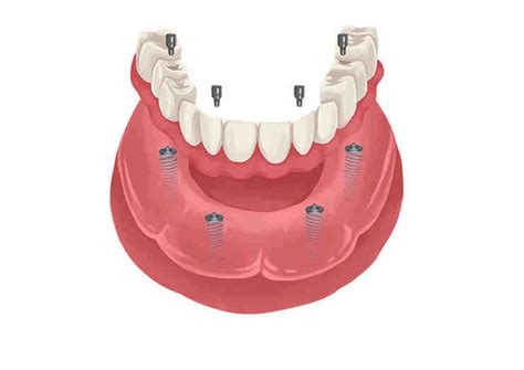 Can You Replace All Of Your Teeth With Mini Dental Implants One At A