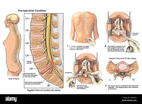 Lumbar Disc Herniation With Surgical Laminectomy And Discectomy The