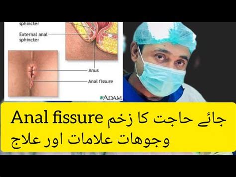 Anal Fissure Causes Symptoms And Treatment For Patients Youtube