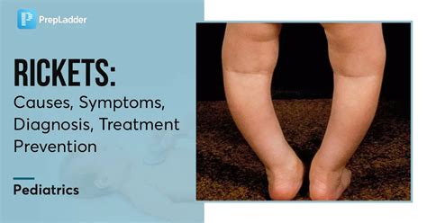 Rickets Causes Symptoms Diagnosis Treatment Prevention