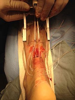 The achilles tendon is the largest and strongest tendon in the human body and is a connector between the heel bone post operative care. Minimally-Invasive Surgical Repair for Achilles Tendon ...