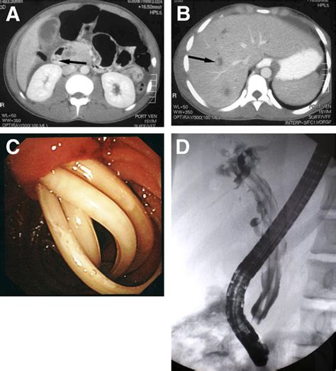 Cholangitis And Pancreatitis Caused By Biliary Ascariasis Clinical