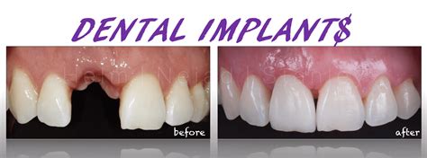 Replacing many teeth with implants. How much are dental implants | Dental Implant Price Factors