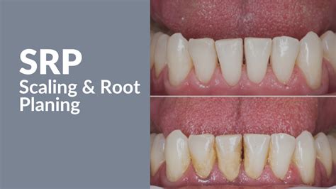 Srp Scaling And Root Planing Successful Billing For Soft Tissue Management