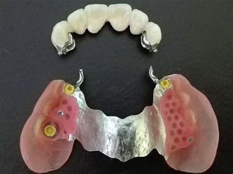 Proteze Dentare Scheletate Vs Proteze Acrilice Clasice Essentialdent Ro