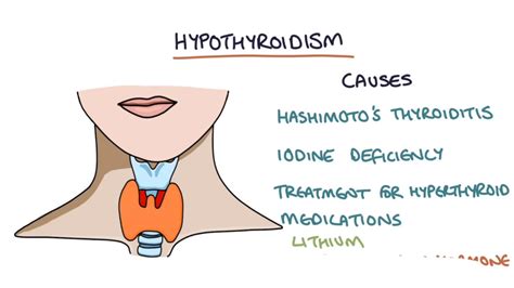 Hypothyroidism And Hashimoto S Thyroiditis Visual Explanation For Students Youtube