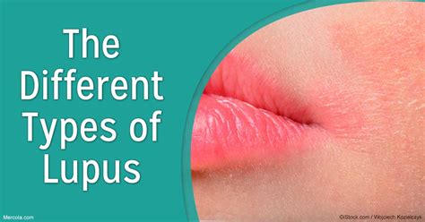 What Are The Different Types Of Lupus