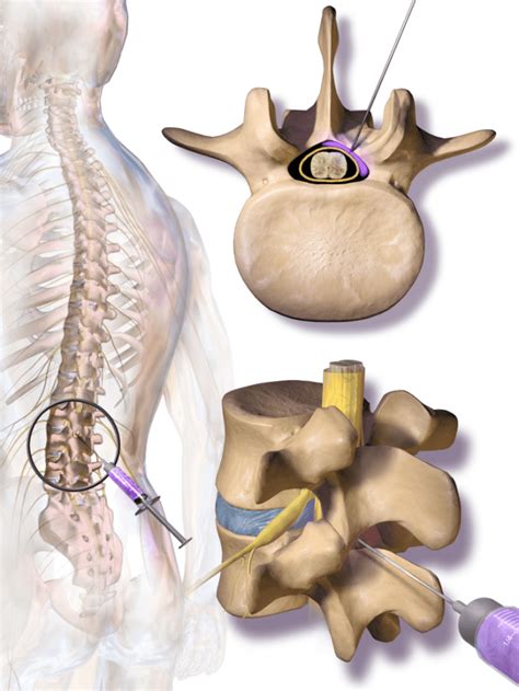 Treatment For Chronic Neck And Back Pain Epidural Steroid Injections