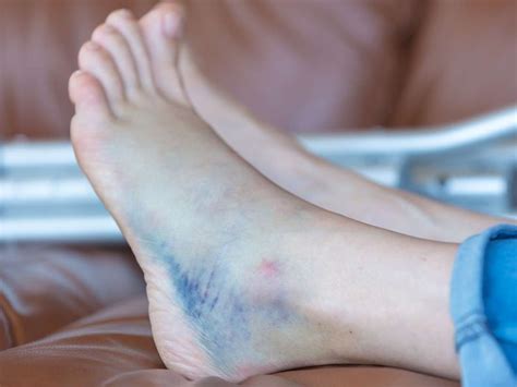 Bruised Heel Remedies And When To See A Doctor