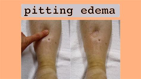 Pitting Edema Symptoms Causes And When To See A Doctor 59 Off