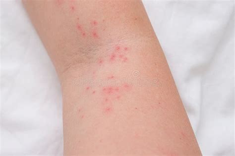 Itchy Skin Bumps On Arms