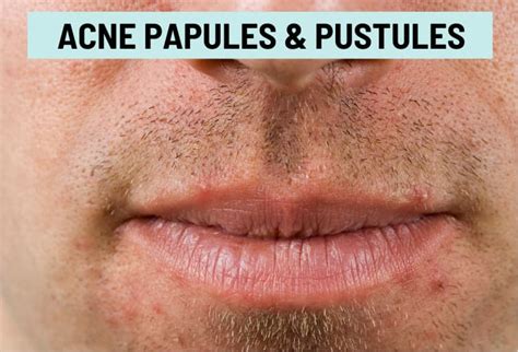 Cold Sore Vs Pimple Pictures And Differences