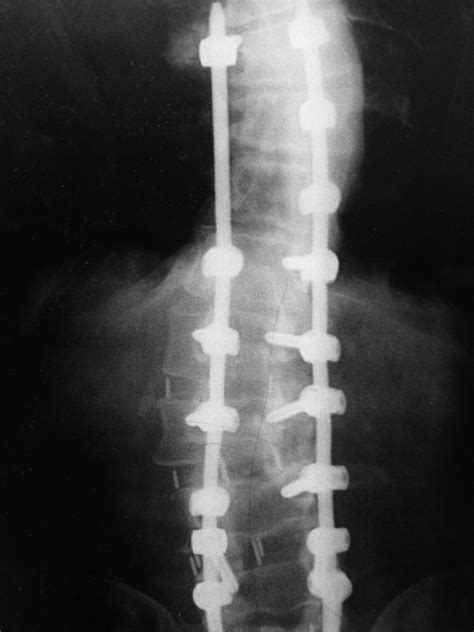 Adult Scoliosis Post Operative Spinecare Medical Group