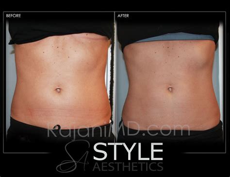 Coolsculpting Weight Loss Fat Removal Reduction Before After Photos Web Portland Oregon 0429