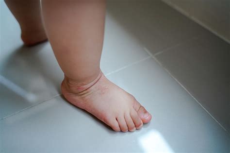 Closeup Focus On Ankle Area Of Small Baby Leg Covered By Eczema With