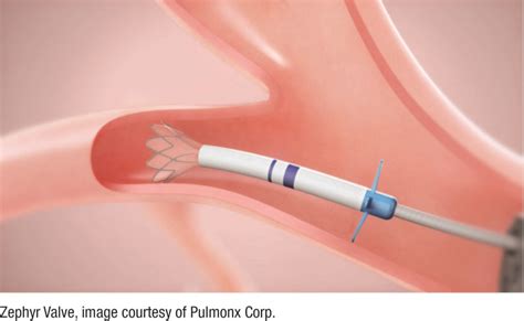 New Option For Severe Emphysema One Way Valves To Reduce Lung Volume