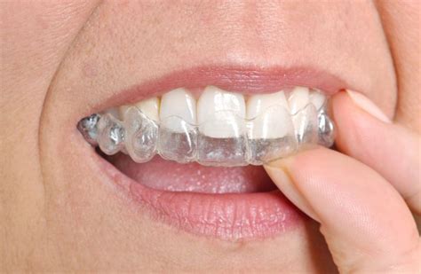Braces In Denton Krum Tx Cramer Orthodontics