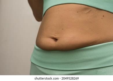 Closeup Woman Showing Loose Skin On Stock Photo 2049528269 Shutterstock