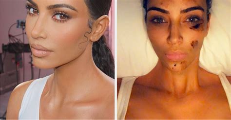 Kim Kardashian Got Hilariously Real About Psoriasis On Instagram