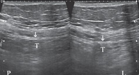 Figure 1 From Intra Abdominal Adhesions In Ultrasound Part I The