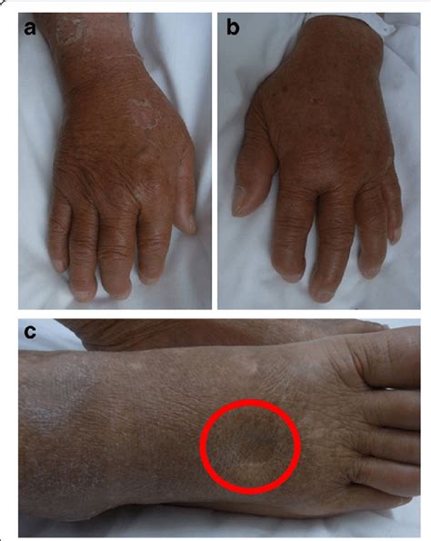 Pitting Edema Could Be Seen On The Patient S Right Hand A Left Hand