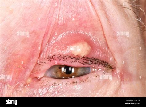Chalazion Cyst On An Eyelid In An Year Old Woman This Condition