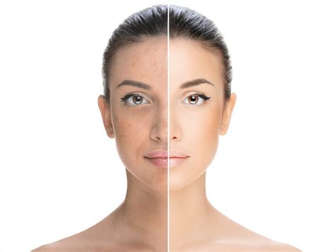 Acne Treatment: Before & After Gallery - SP Derma Center