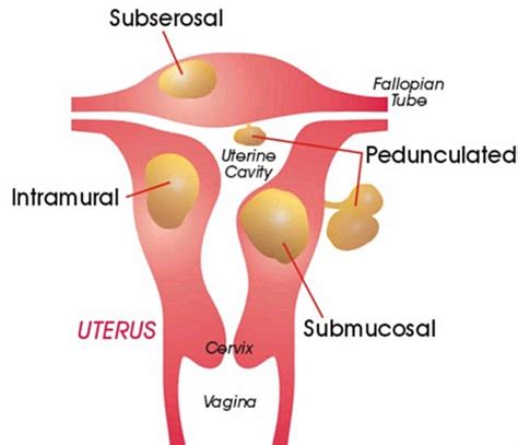 Leiomyoma Uteri Uterine Fibroid Symptoms Types Pregnancy Effects