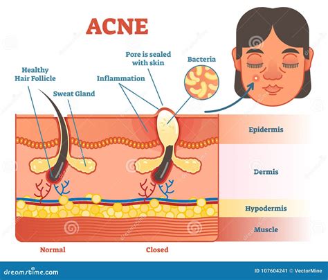 Ilustra O Do Diagrama Da Acne Com Cabelo Espinha Camadas Da Pele E Estrutura Cara F Mea Ao